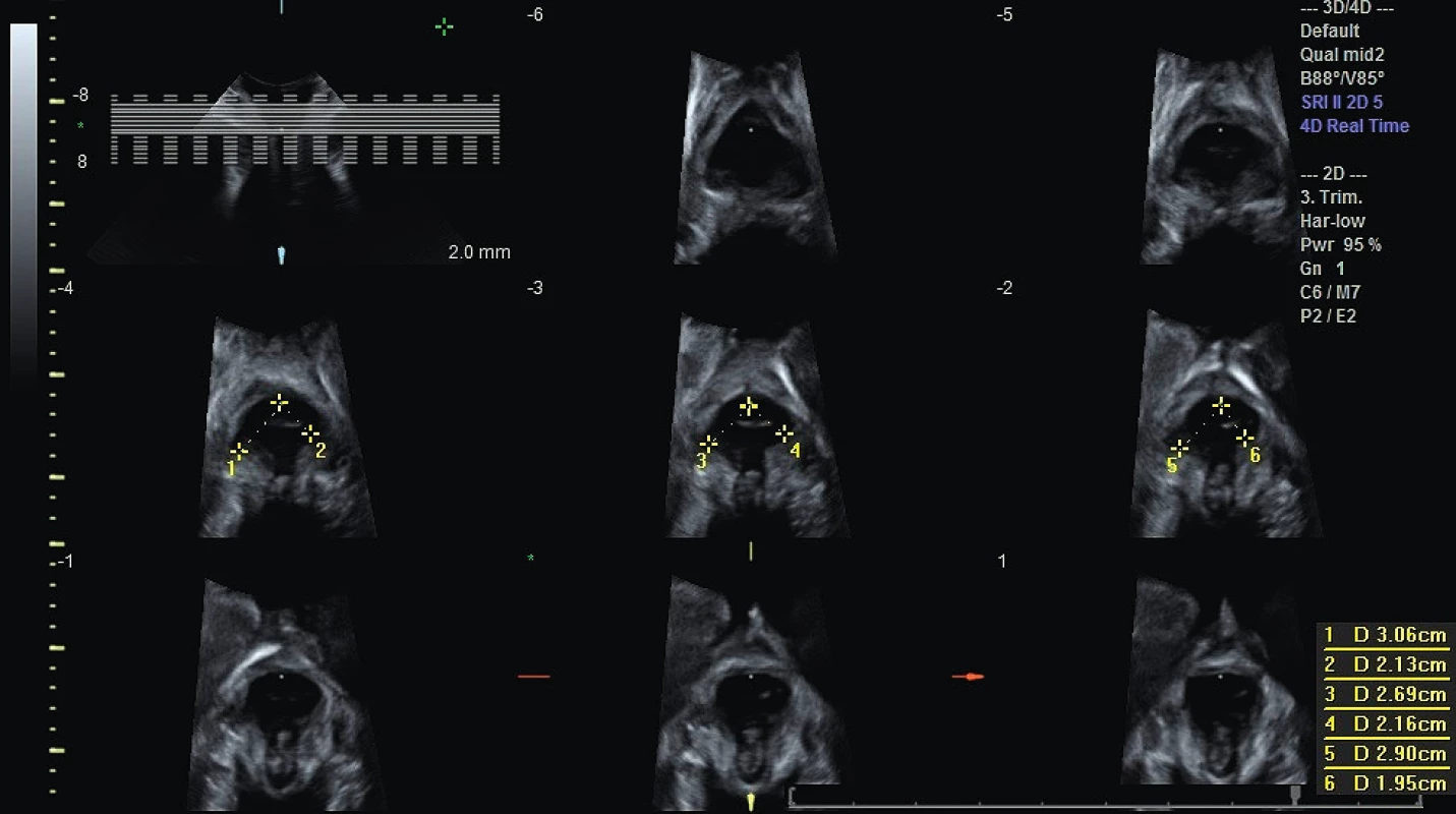 Sonografická tomografie (TUI) a hodnocení avulze MLA ve
třech centrálních snímcích pomocí vzdálenosti levator-urethra gap