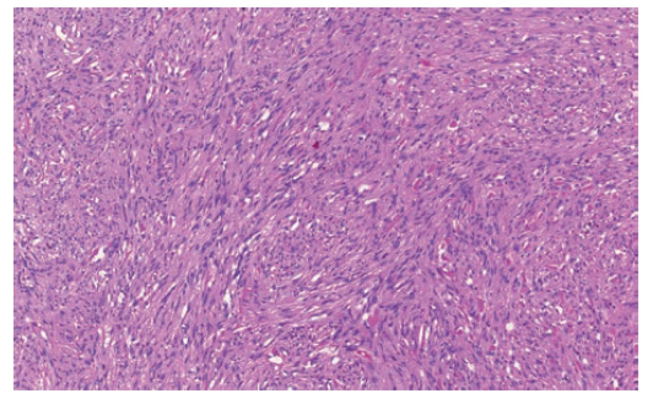 GIST v hematoxylin-eosinu je přehledné a detailní
zvětšení ohraničené léze s charakteristickým storiformním
uspořádáním a blandními buňkami<br>
Fig. 1. GIST in hematoxylin-eosin: a clear and detailed
enlargement of lesion with a characteristic storiform
pattern and bland cells