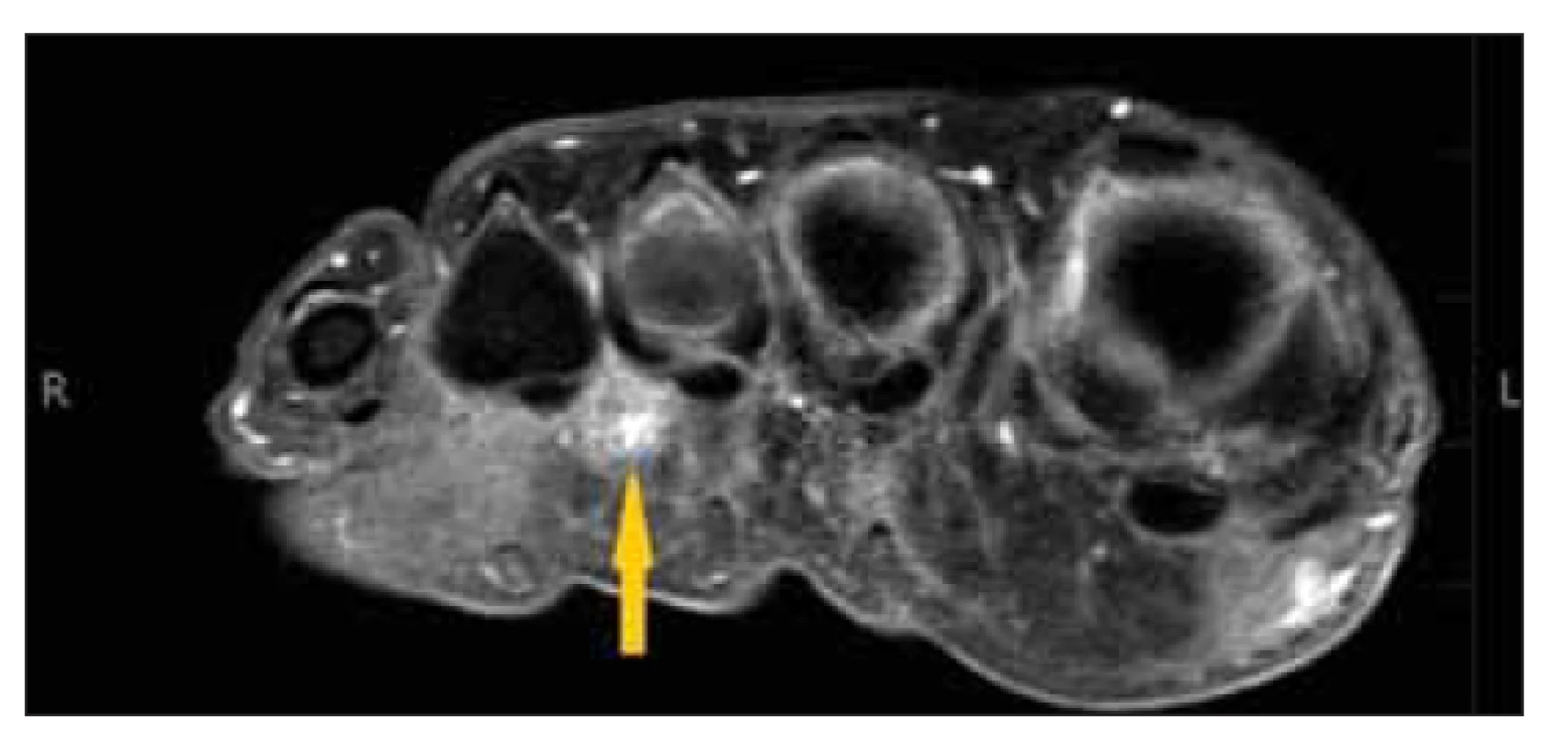 MR, vážení spirT1. Mortonův neurom (šipka).<br>
Fig. 3. MRI, T1 spir. Morton’s neuroma (arrow).
