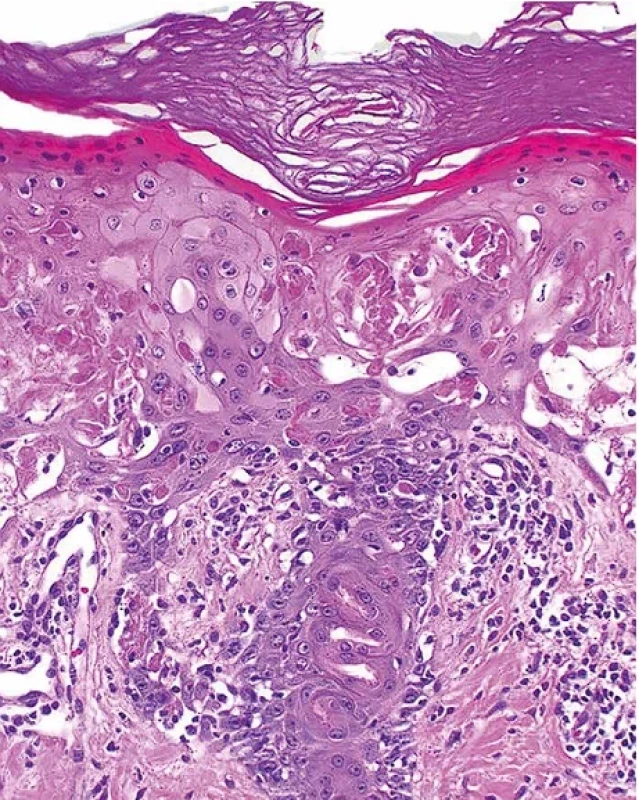  Toxická epidermální nekrolýza, časná stádia – histopatologický obraz. Postižení epitelu vývodů potních žláz. Hematoxylin-eozin, pův. zvětšení 200x.