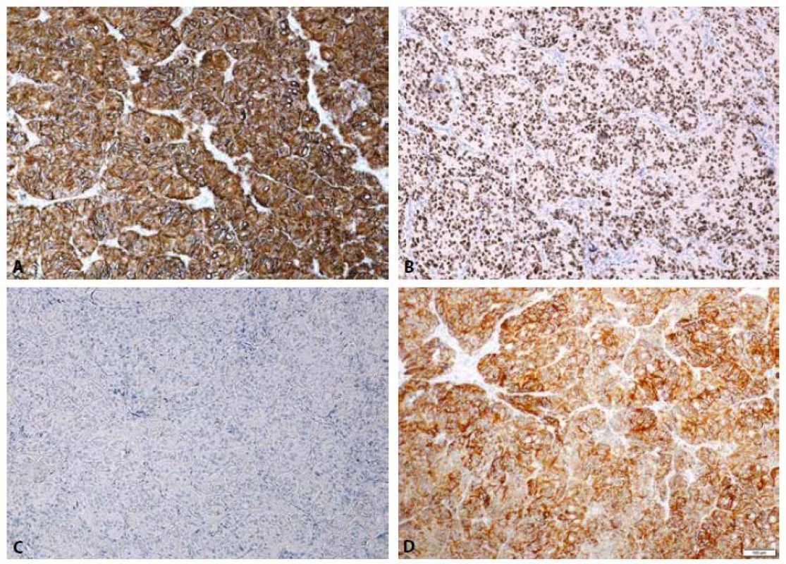Imunohistochemický nález: Silná membránová pozitivita Ki-67 (A, zvětšení 100x). Pozitivní jaderná exprese TTF-1 (B, zvětšení 100x). Negativní exprese
CK19 (C, zvětšení 100x). Pozitivní membránová exprese CD56 (D, zvětšení 100x). Negativní exprese HMBE-1 není znázorněna.