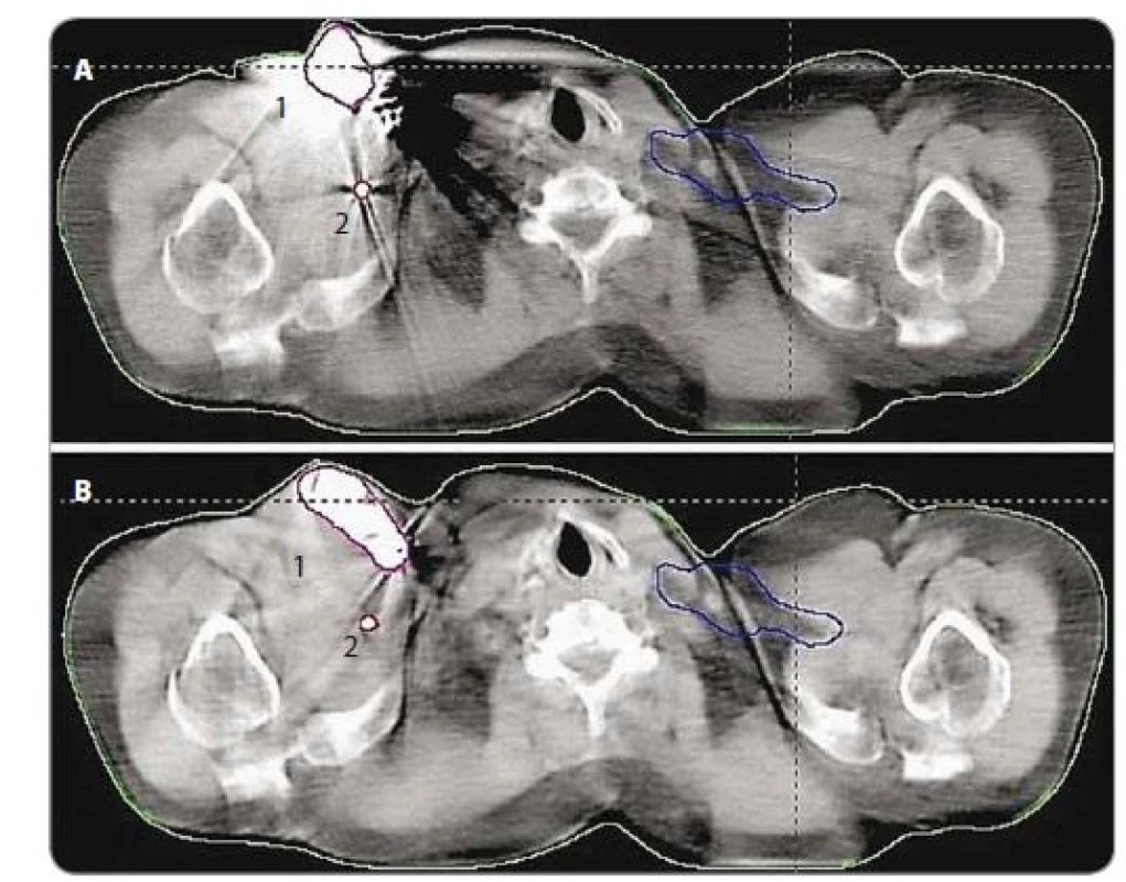 CT scans with (a) and without (b) metal artifacts, where 1 and 2 correspond to the
cardiac device and leads respectively.