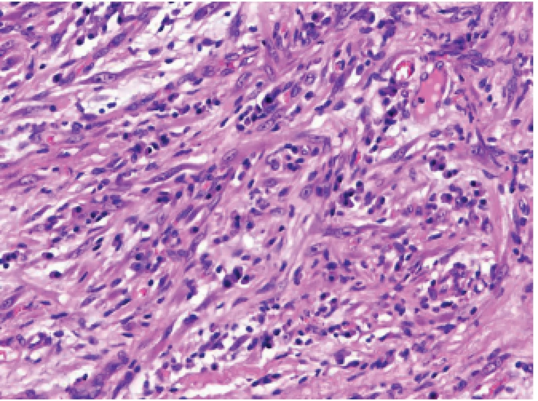 Infl amatorní myofi broblastický tumor.V infl amatorním myofi broblastickém tumoru je, podobně jako v sarkomu z folikulárních dendritických
buněk, intimní vztah nádorových dužnatých vřetenitých buněk s  buňkami
chronického zánětlivého infi ltrátu (HE, 200x).