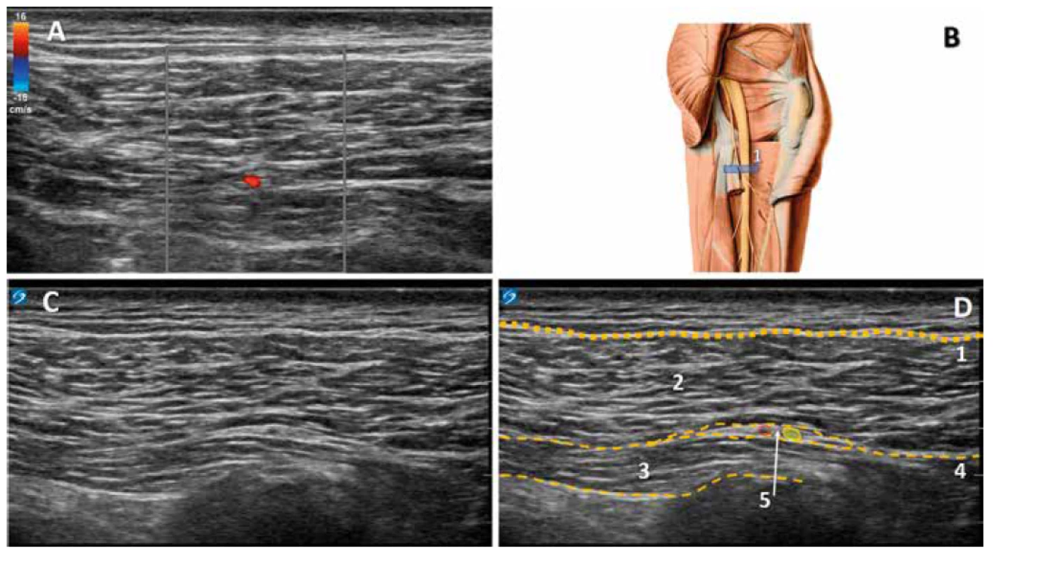 Identifikace NCFP v subgluteální krajině. A: dopplerovský obraz cévy a nervu mezi svalovými fasciemi. B: ilustrativní anatomický obraz, 1. poloha
sondy. C: nativní ultrazvukový obraz subgluteální krajiny. D: kolorovaný obraz, 1. fascia lata, 2. m. gluteus maximus, 3. dlouhá hlava m. biceps femoris,
4. mezisvalová fascie, 5. nervově‑cévní
svazek obsahující NCFP