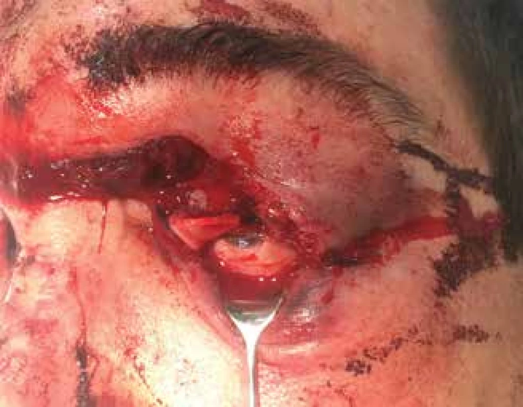 a. Industrial injury by saw. The wound on the upper eyelid is deep enough to cause damage to the musculus levator
palpebrae superioris