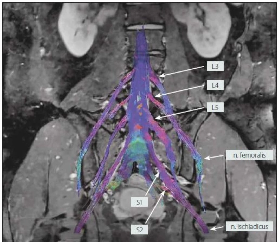 MR traktografie oboustranného lumbosakrálního plexu u zdravého dobrovolníka (muž, 25 let).<br> Fig. 5. MR tractography of the bilateral lumbosacral plexi in a healthy volunteer (male, 25 years).
