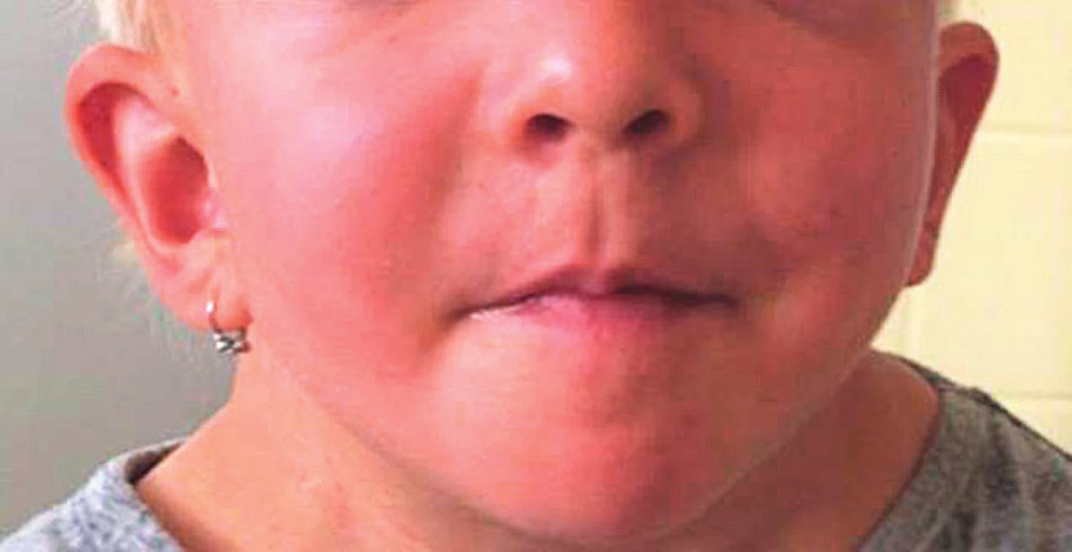 Nápadně nízko posazené ušní boltce u dívky s patogenní variantou genu SHOC2.<br>
Fig. 4. Apparently low-set ears in a girl with pathogenic
SHOC2 gene variant.