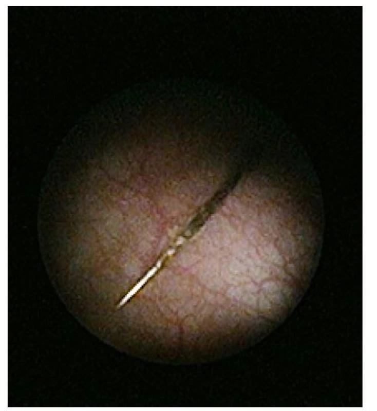 Endoskopický nález cizího tělesa<br>
Fig. 5. Endoscopic finding of foreign body