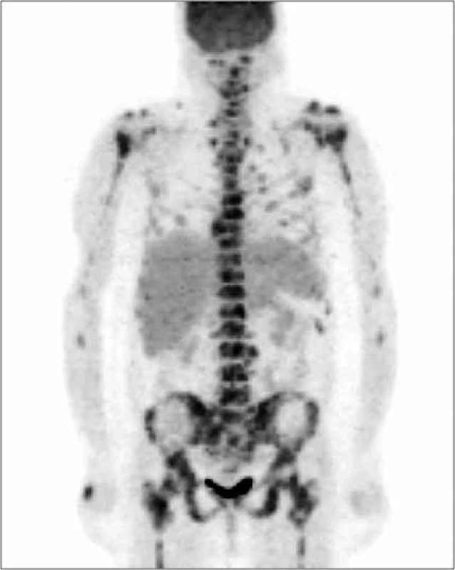 Vyšetrenie zobrazovacími metódami: PET-CT –
skeletálne metastázy. Archív Onkologického
ústavu sv. Alžbety, s.r.o., Bratislava