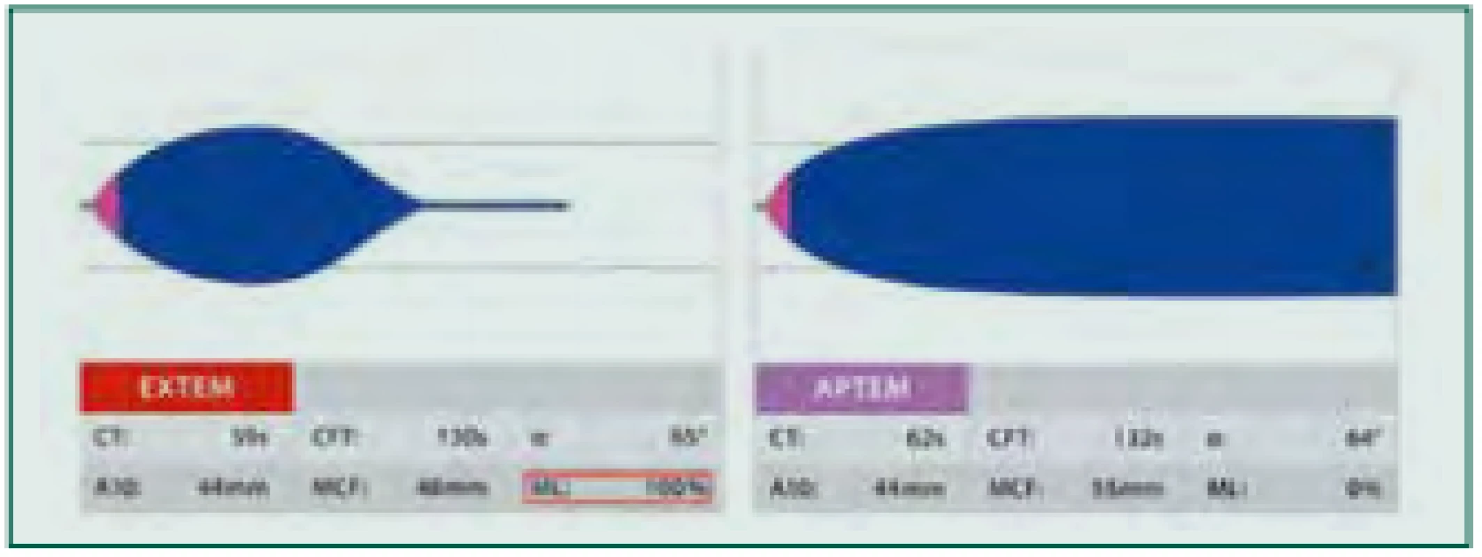 Hyperfibrinolýza: Provedený test EXTEM s patologickým tvarem
křivky a patologickými hodnotami parametrů LI30, LI60 či ML (červený ráme‑
ček, normální hodnoty 0–15 %) může znamenat zvýšenou míru fibrinolýzy.
K ověření je proveden test APTEM s antifibrinolyticky působícím aprotininem.
Při normalizaci tvaru křivky a parametrů lýzy přichází v úvahu terapie anti‑
fibrinolytiky, např. kyselinou tranexamovou.