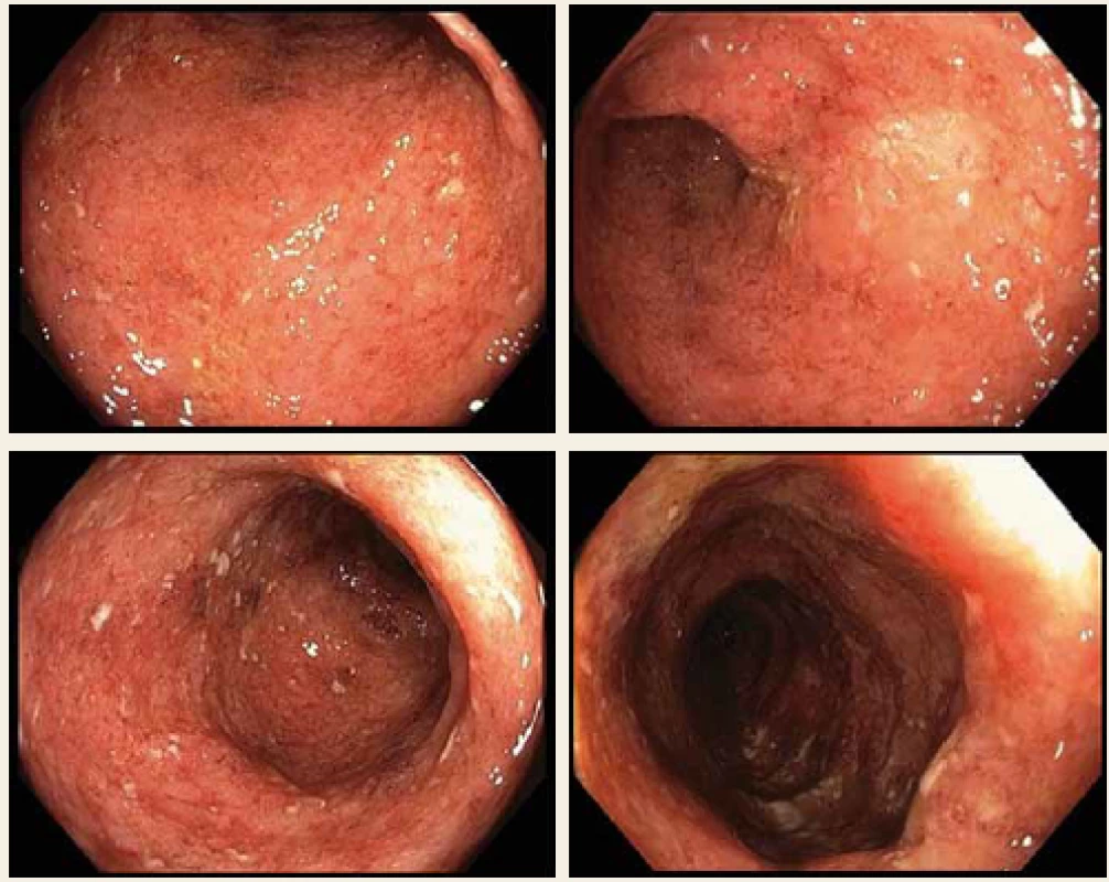 Koloskopie před zahájením biologické léčby, Mayo subscóre = 3.<br>
Fig. 1. Colonoscopy before biological treatment, Mayo subscore = 3.