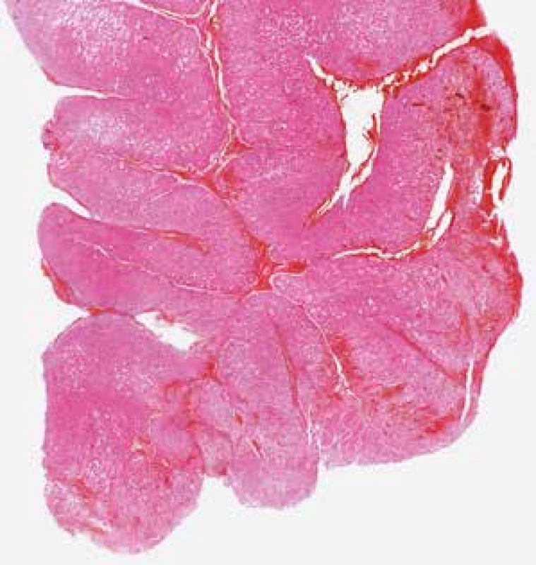 Deformovaná mozečková folia, hematoxylin-eosin, 50x.