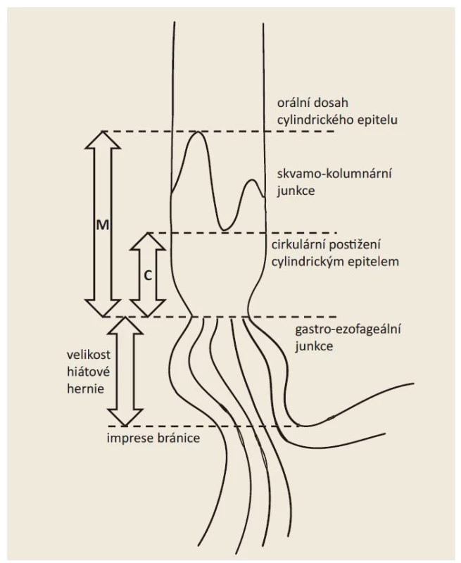 Schéma Pražské klasifikace.<br>
Fig. 3. Prague classification scheme.