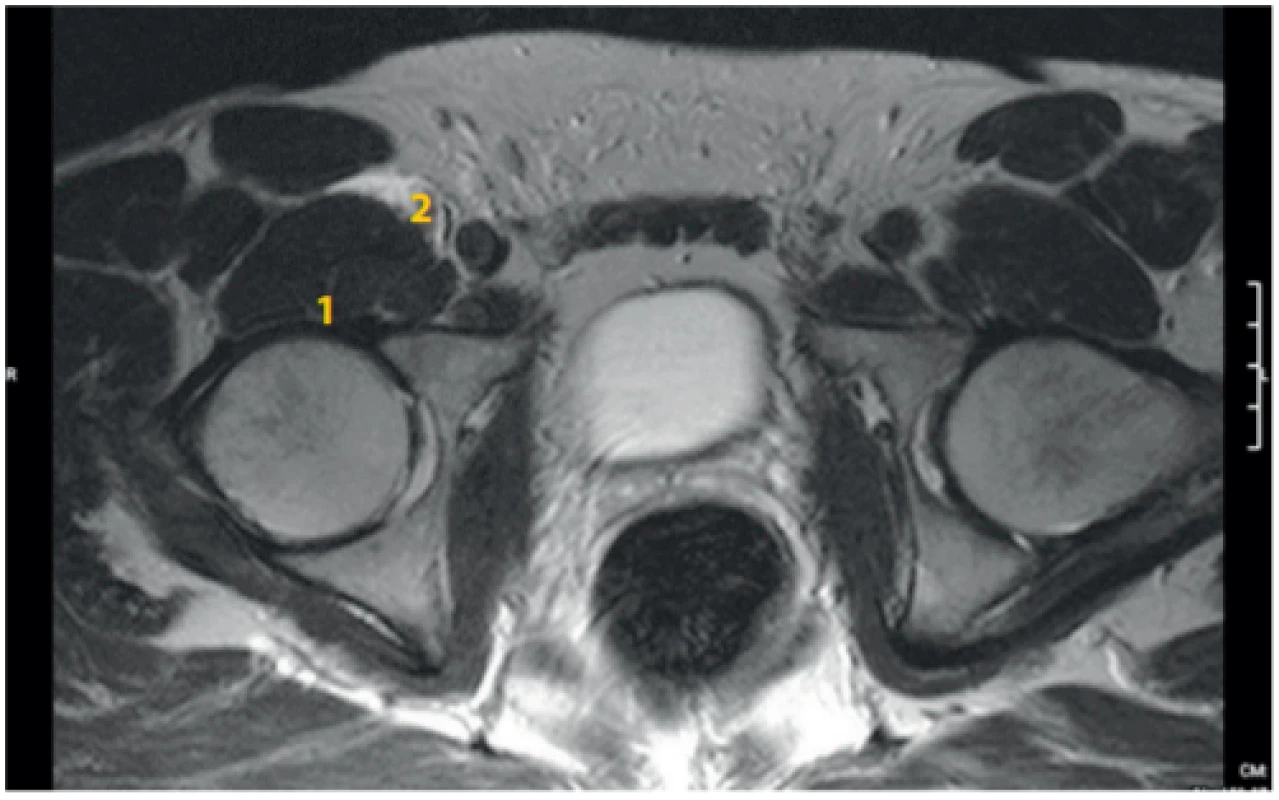 MRI dutiny břišní u stejného dobrovolníka jako u obr. 8, vertikální
řez, po podání 20 ml fyziologického roztoku cestou psoas compartment blok
ve výši L2–3 vlevo a 20 ml fyziologického roztoku cestou infrainguinálního
femorálního bloku (3 in 1) vpravo: horizontální řez pánví v úrovni kyčelního
kloubu. 1. m. ilopsoas, 2. přítomnost tekutiny v iliopsoatické fascii po aplikaci cestou infrainguinálního podání vpravo (náplň byla identifikovatelná
do úrovně S4). Na levé straně již není patrná náplň z bloku z oblasti psoas
kompartmentu L2–3