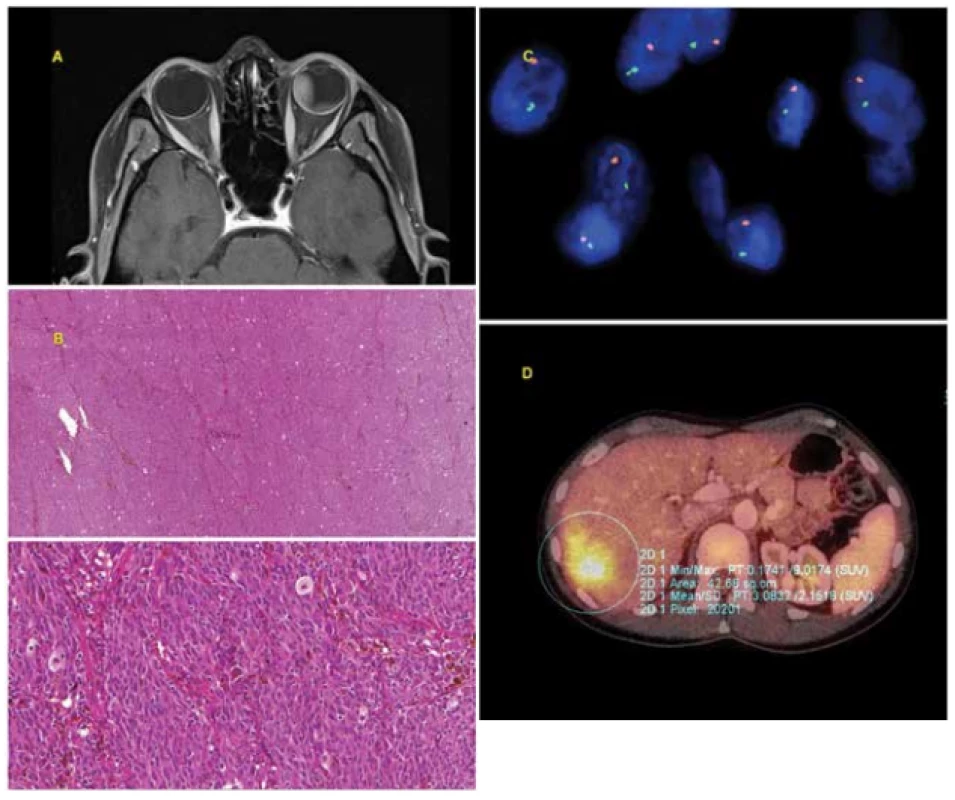 30-year-old woman with advanced choroidal melanoma of the left eye, diagnosed in July 2010. After treatment with Leksell 
gamma knife in August 2010 the tumour progressed, and as a result enucleation of the eyeball was performed in October 2010. The 
histological (mixed type melanoma, pleomorphism) and cytogenetic (monosomy of chromosome 3 – positive, gain in chromosome 
6p, i.e. iscochromosome 6p – negative, gain in chromosome 8q – negative) examination indicated an unfavourable prognosis. Within 
the framework of regular monitoring, metastatic affliction of the liver was determined in April 2014. Chemotherapy was commenced, 
due to progressing generalisation with multiple organ affliction biological therapy was also subsequently applied. In October 2014 the 
patient died from the consequences of generalisation of uveal melanoma.<br>
A: Advanced choroidal melanoma of the left eye visible on MR image from July 2010.<br>
B: Histological finding – solid alveolar type growth, tumorous proliferation of epitheloid and spindle-cell elements (formed by spindle-cells type B), isolated with deposits of brown melanin pigment.<br>
C: Loss of chromosome 3 detected by FISH method with the use of a fluorescence probe VHL/CEN 3 (Zytovision, Germany). The locus 
of VHL (3p25.3) is indicated by green colour, the control centromeric area (CEN 3) is indicated by orange colour, the nuclei are tinged 
with blue DAPI. In normal nuclei with two chromosomes, 2 green and 2 orange signals are expected. Loss of chromosome 3 is visible 
in the image (only 1 green and 1 orange signal).<br>
D: Metastasis in liver visible on PET/CT examination.