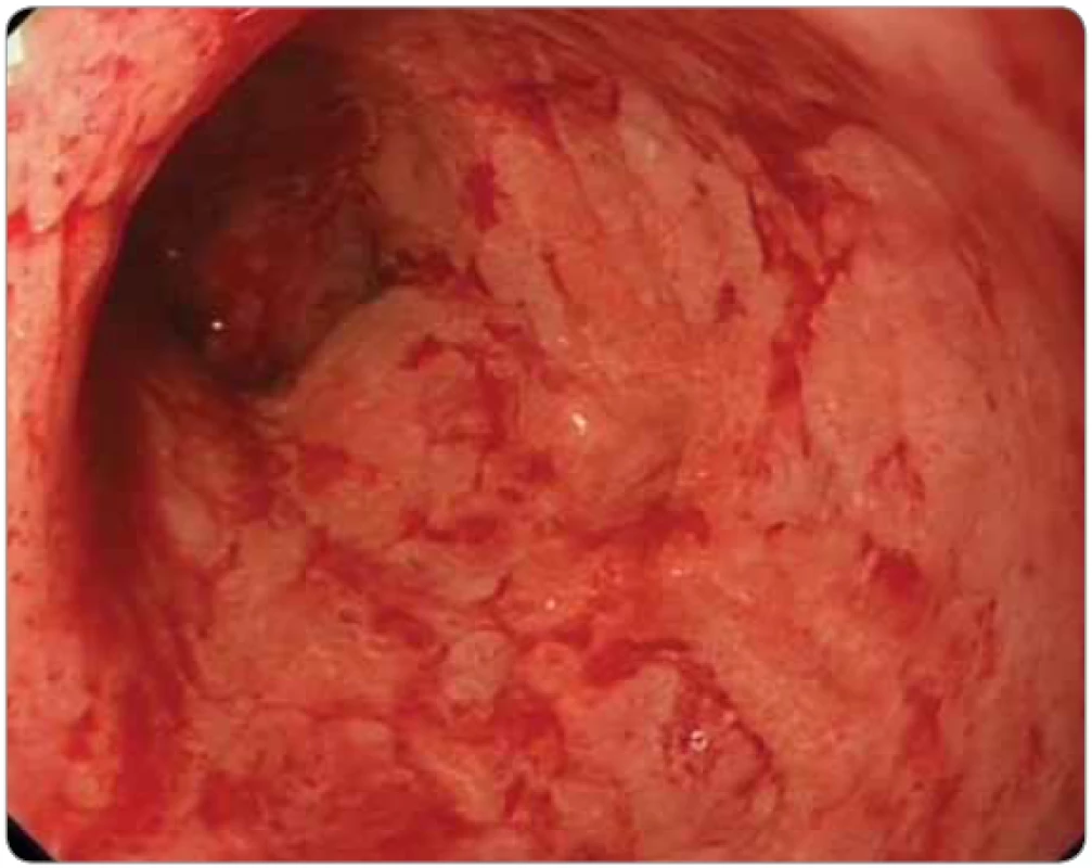 Imunoterapií indukovaná kolitida (nivolumab pro maligní melanom) u 51letého
pacienta. Koloskopie: sliznice sigmatu je edematózní, s vymizelou cévní kresbou,
fragilní, spontánně krvácející, s naznačeným nodulárním reliéfem. Nemocný byl léčen
vedolizumabem. Nelepšící se stav si vyžádal subtotální kolektomii.