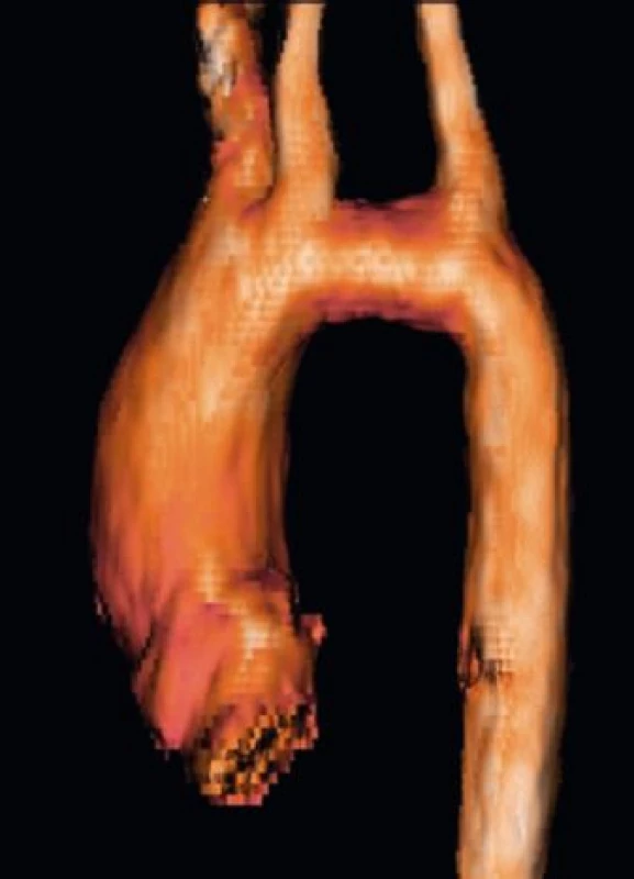 Elongace transverzálního aortálního oblouku – 3D rekonstrukce
z vyšetření magnetickou rezonancí (archiv
autorů).<br>
Fig. 5. MRI reconstruction image demonstrating elongated
transverse aortic arch (authors archive).