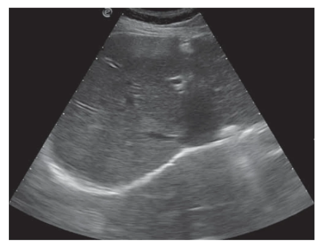 USG nález ľahkej steatózy pečene (zvýšenie echogenity)
a hraničnej dilatácie intrahepatálnych žlčovodov.<br>
Fig. 1. USG finding of mild hepatic steatosis (increased echogenicity)
and borderline dilatation of intrahepatic bile ducts.