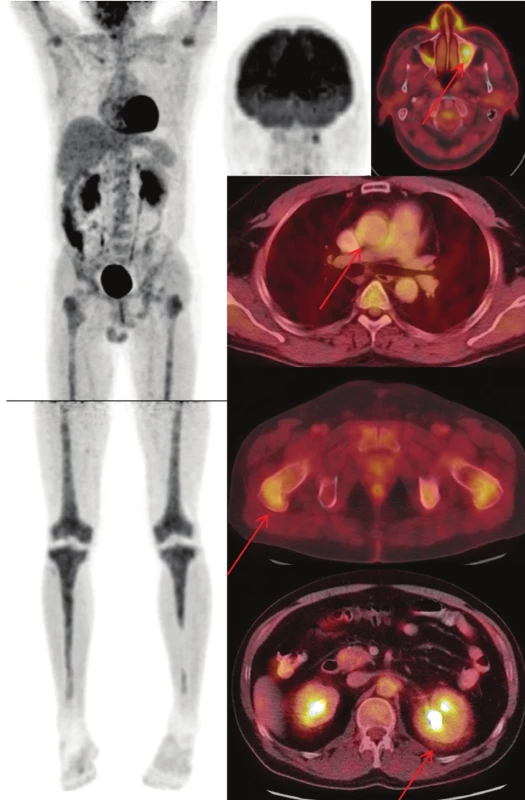 (nahoře) Sumarizace nálezů
  <sup>18</sup>F-FDG PET/CT vyšetření u pacienta
č. 2. Černobílé MIP projekce ukazují
rozsah snímání, odráží i rozsah kostního
postižení. Fúzované obrazy pak ukazují
detaily paranasálního, kardiovaskulárního,
kostního, retroperitoneálního
postižení.