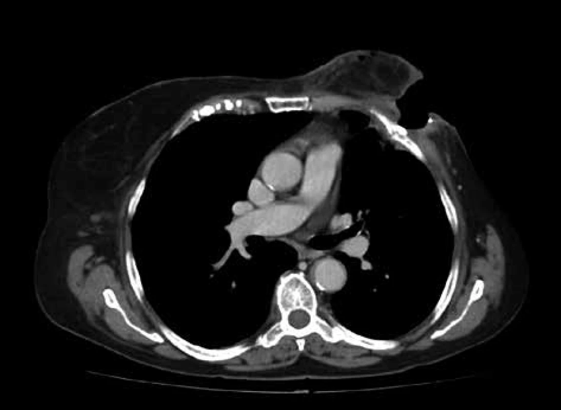 CT hrudníku – patrná usurace žeber a  pleurální
adheze<br>
Fig. 1: CT chest scan – noticeable ussurated ribs and pleural adhesions
