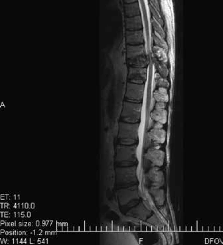 Vyšetrenie zobrazovacími metódami:
MRI-zobrazenie metastáz chrbtice.
Archív Onkologického ústavu sv. Alžbety, s.r.o.,
Bratislava