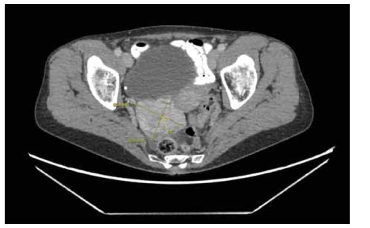 Předoperační tomografie s kontrastní látkou.<br>
Fig. 2. Preoperative computer tomography with a contrast agent.