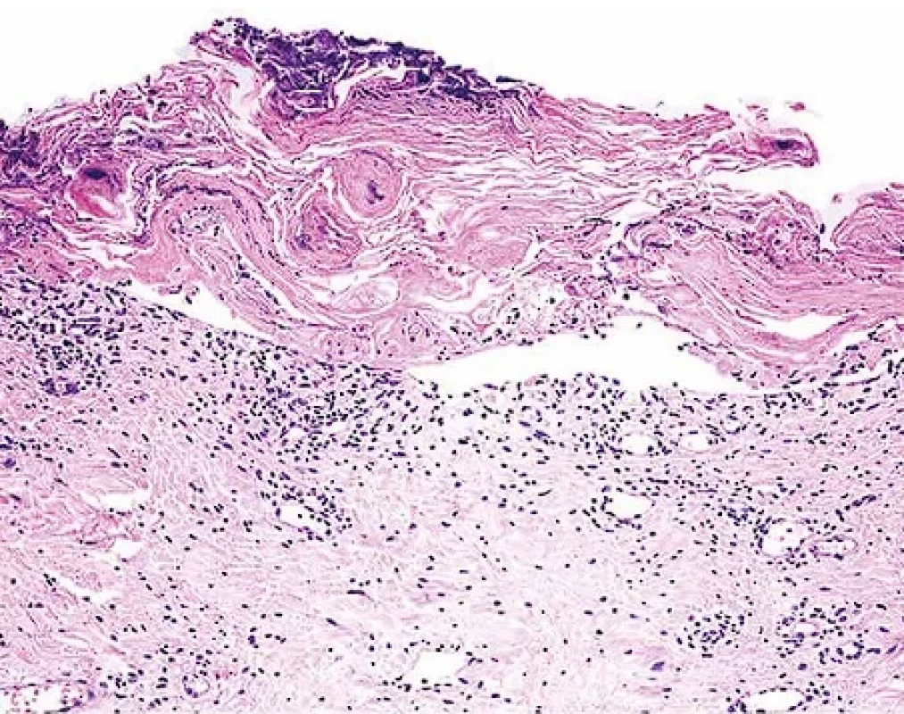 Toxická epidermální nekrolýza, vyvinutá léze – histopatologický obraz. Kompletní nekrolýza a odloučení epidermálního krytu. Hematoxylin-eozin, pův. zvětšení 200x.
