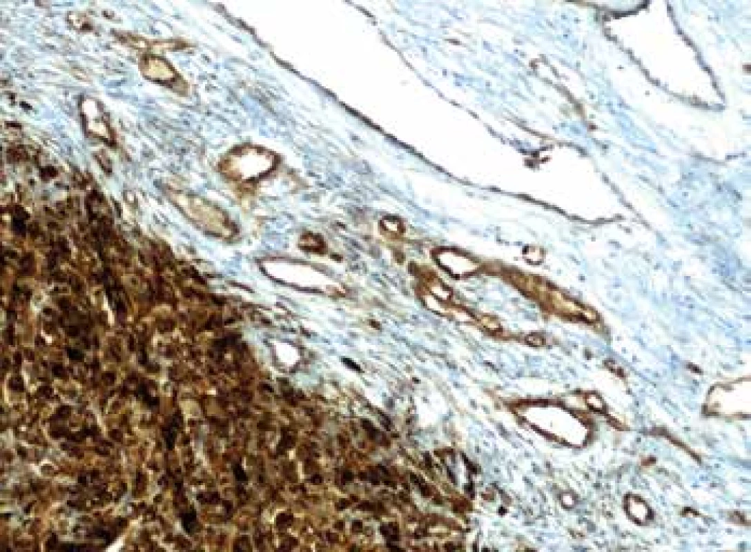 Imunohistochemický průkaz protilátky anti-Nestin v novotvořených
kapilárách na periferii tumoru (zvětšení 200x).
