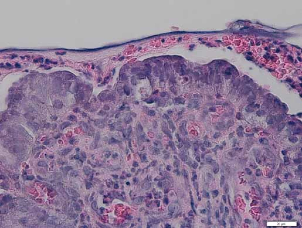 Histologie – polypózní adenomatózní léze s lehkou
až střední dysplazií povrchového epitelu. Zvětšeno 400×.