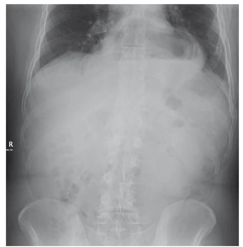 Nativní RTG snímek břicha vstoje, velká hiátová hernie žaludku
s hydroérickým fenoménem (hladinkou).<br>
Fig. 3. Abdominal X-ray, a large hiatal hernia with air-fluid level.