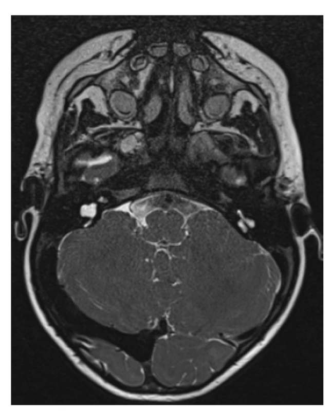 Common cavity