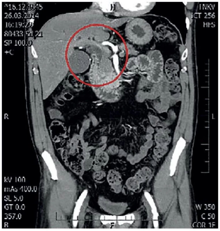 MDCT s nálezem double duct sign
V červeném kruhu dilatace hepatocholedochu. <br> 
Fig. 2: MDCT with double duct sign
Dilatation of the common bile duct is captured in the red circle.