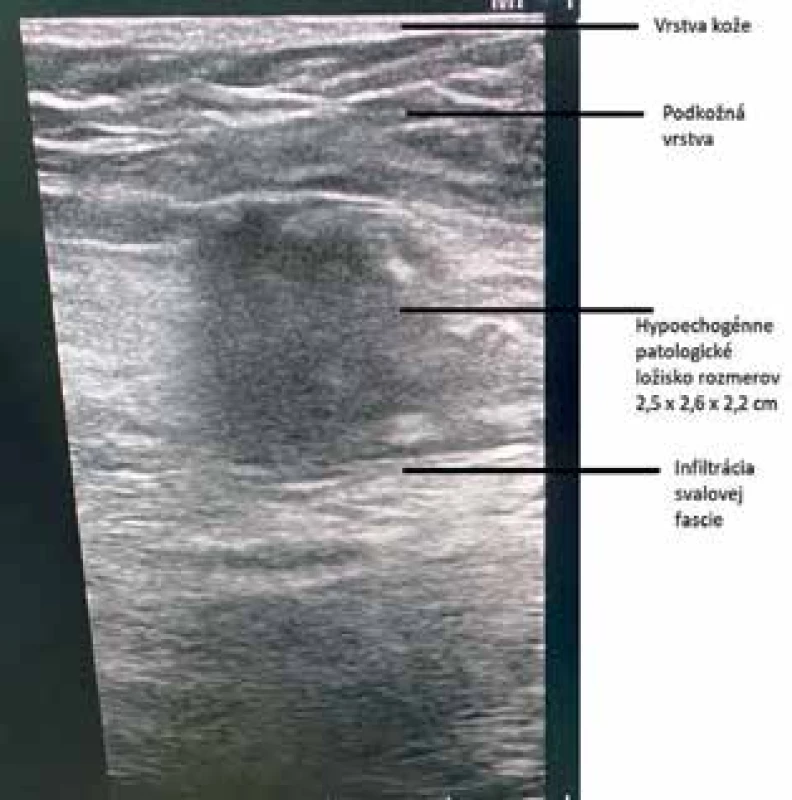 USG brušnej steny: neostro ohraničené hypoechogénne ložisko rozmerov 2,5×2,6×2,2 cm v úrovni svalovej 
vrstvy v pravom hypogastriu<br>
Fig. 1: Abdominal wall US: hypoechogenic lesion 
2,5×2,6×2,2 cm infiltrating the muscular layer