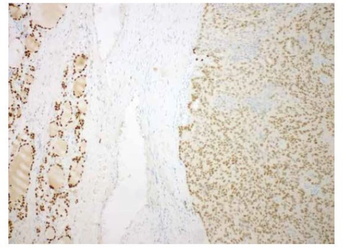 Imunohistochemický průkaz slabé exprese TTF1 (vpravo) ve srovnání
s normálními folikulárními buňkami (vlevo); (zvětšení 100x).