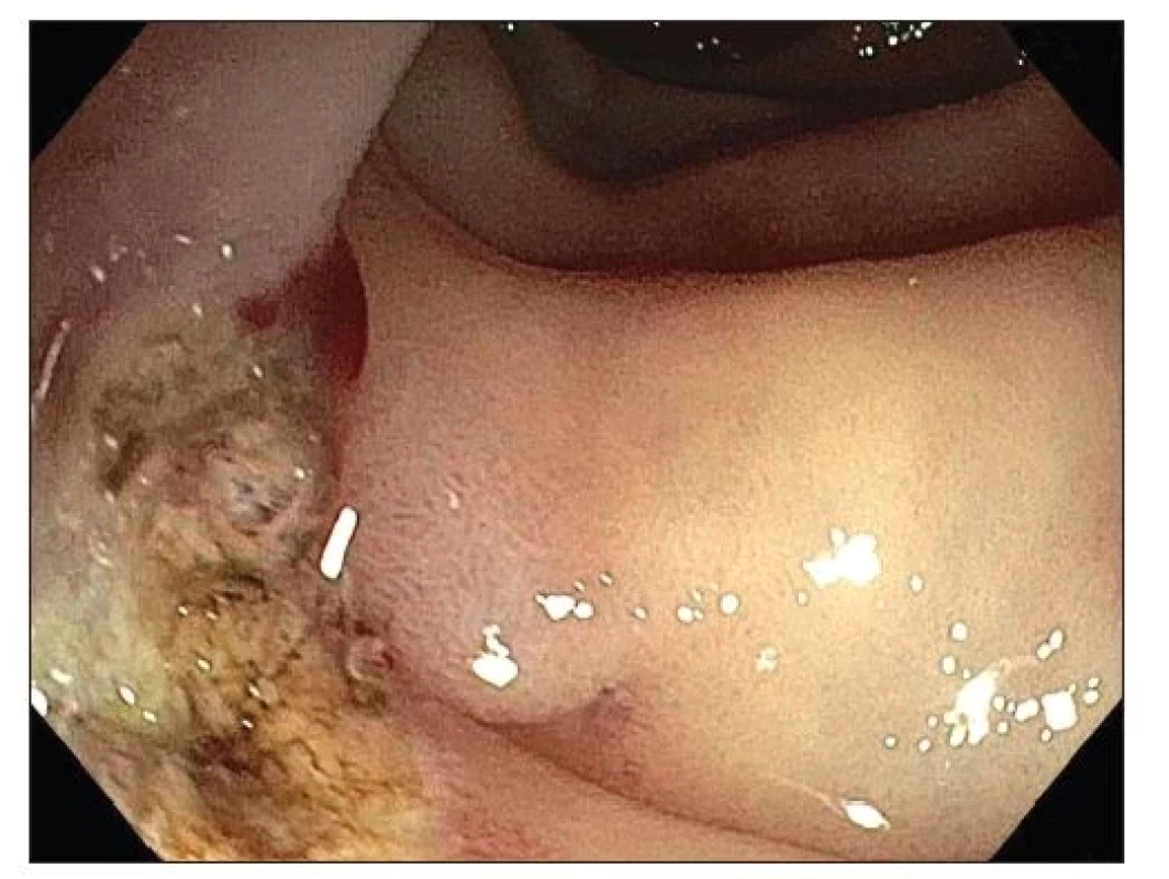 Angiodysplazie proximálního jejuna po opichu adrenalinem .
