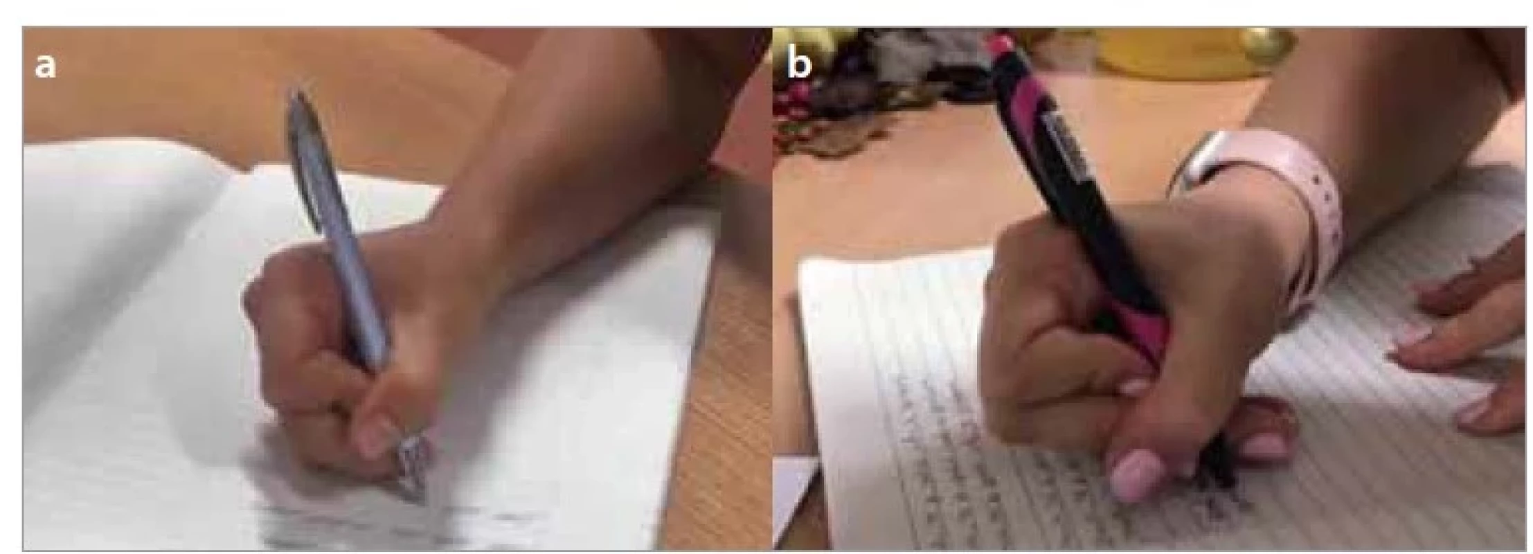 a,b. Boční palcový úchop s palcem přes ukazovák – a) tříprstý, b) čtyřprstý.<br>
Fig. 5a,b. Lateral thumb wrap grip – a) thumb wrap tripod grip, b) thumb wrap
quadruped grip.