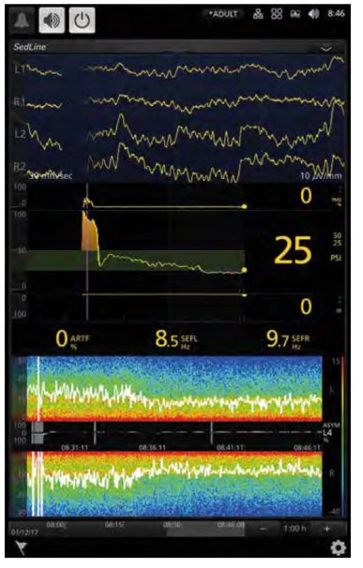 Displej monitoru SedLine: v horní části jsou čtyři svody EEG z čela,
úsek mezi dvěma tečkovanými svislými čarami odpovídá jedné sekundě.
Svislá fialová čára značí úvod do anestezie. Pod EEG je zobrazena EMG
aktivita 0 % a její trend v čase (na počátku je viditelné zvýšení EMG aktivity
po podání sufentanilu), index hloubky anestezie PSI (Patient State Index)
většinu doby v doporučeném rozmezí 25–50, SR (Suppression Ratio) 0
a jeho trend. Délky trendů lze nastavit. Níže je podíl artefaktů (ARTF %), SEFL
a SEFR jsou hodnoty Spectral Edge Frequency Left a Right, 8,5, resp. 9,7 Hz.
Tyto dvě hodnoty znamenají frekvenci, pod níž je 95 % výkonu signálu EEG.
V dolní části je spektrální analýza EEG (viz další článek) po dobu 20 minut