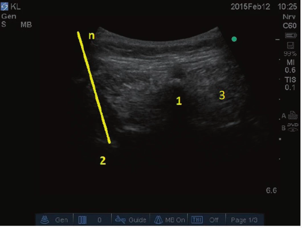 Anatomie pro blokádu ramus medialis (inervace
facetového kloubu) v bederní oblasti. 1 – obratlový trn, 2 –
příčný výběžek obratle, 3 – paravertebrální svaly, n – jehla