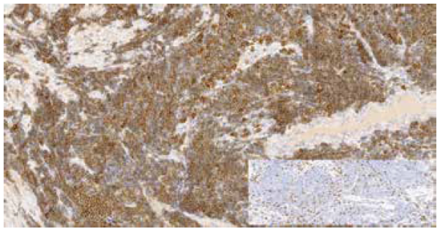 Imunohistochemický průkaz CD20 pozitivních buněk MCL, v pravém
dolním rohu vložen obrázek imunohistochemického průkazu CD3 – reaktivní
T-lymfocyty (zvětšeno 200x).
