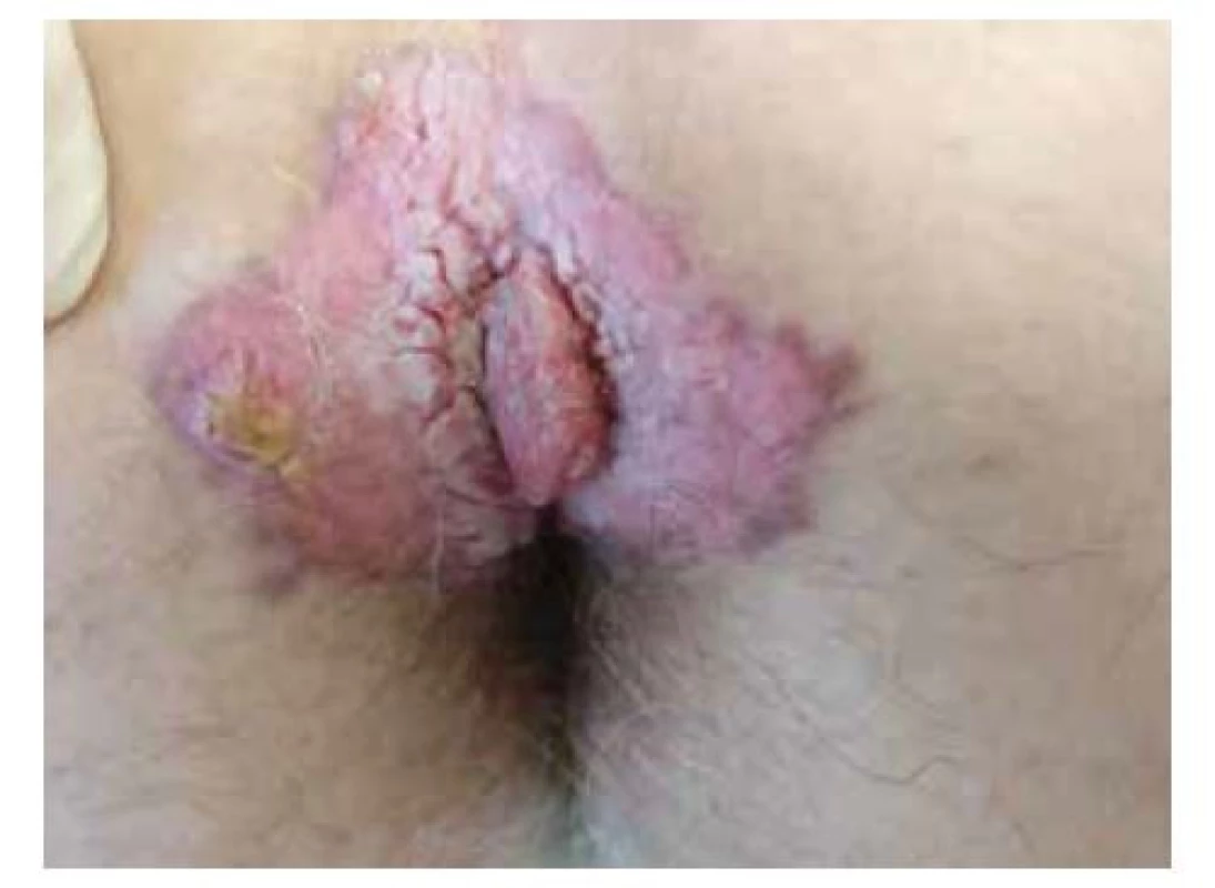 Anální karcinom<br>
(archiv Chirurgické kliniky 2. LF UK a FN Motol)