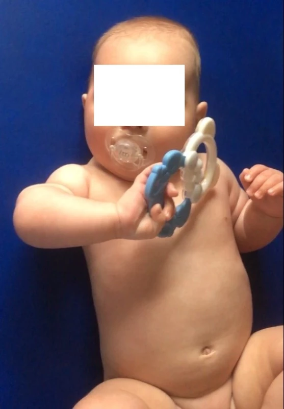  Věk 4 měsíce, při úchopu hračky patrná nedostatečná zevní rotace v ramenním kloubu, postavení je ve vnitřní rotaci, předloktí je v pronačním postavení, aktivní supinace vázne.<br>
Fig. 1. Age 4 months, in the grip of the toy apparent lack of external rotation in the shoulder joint, the position is in internal rotation, the forearm is in pronation position active supination flounders.