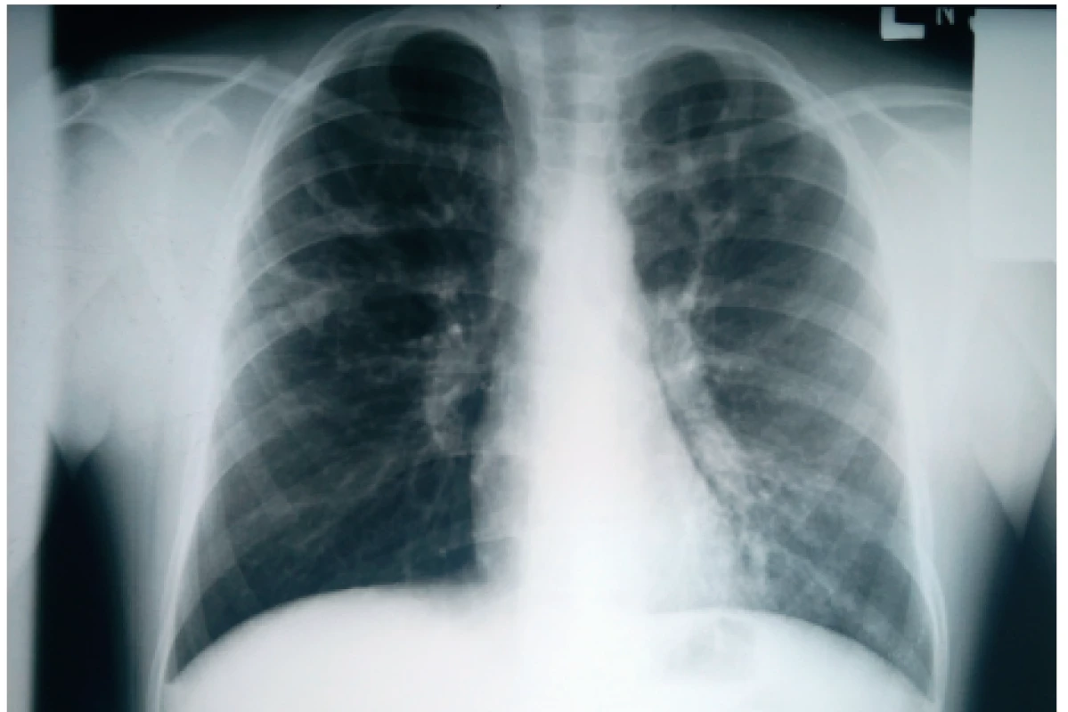 Hlienový odliatok vypĺňajúci celý ľavý bronchus
u nášho pacienta (#004).<br>
Fig. 2. Mucus impaction filling whole left main bronchus in
our patient (#004).