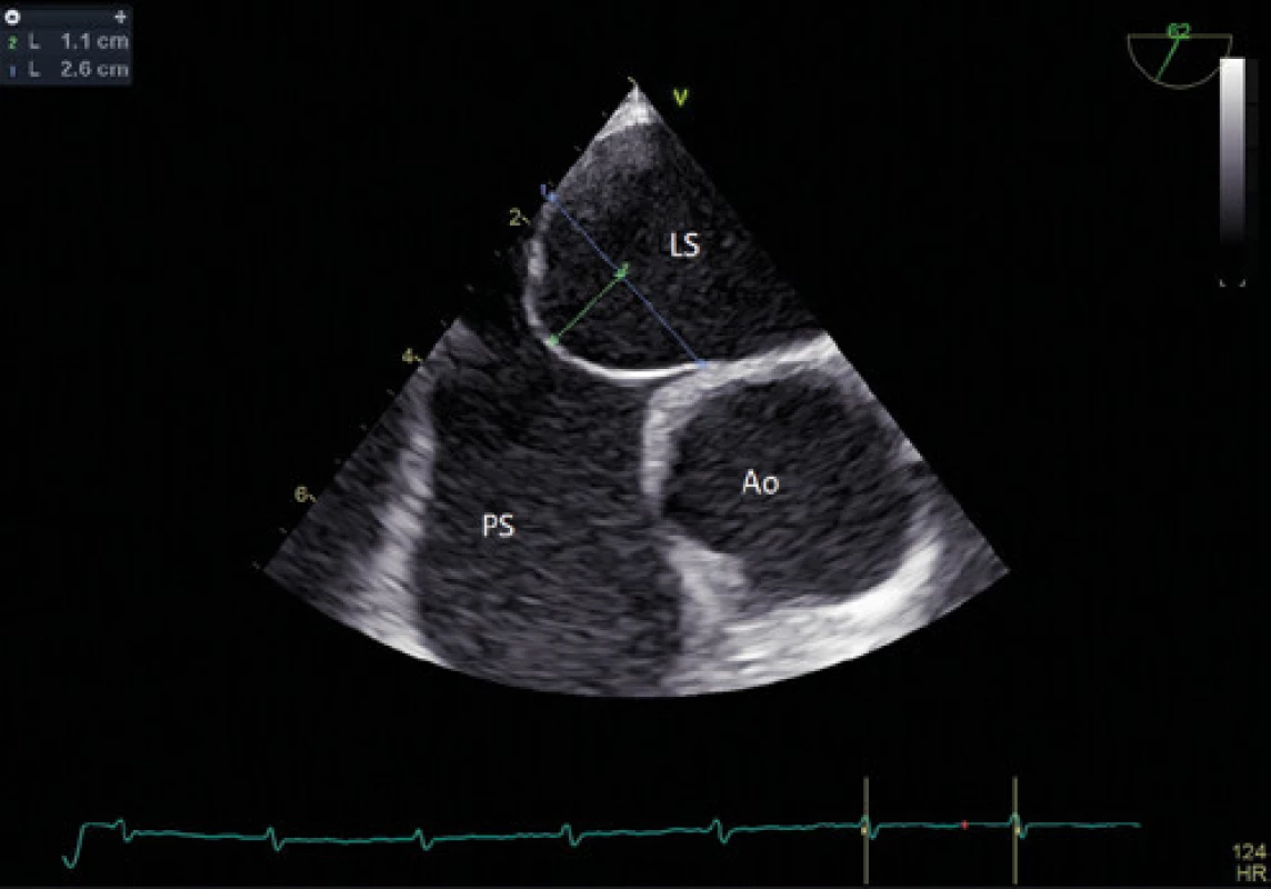 Aneurysma mezisíňové přepážky – TEE