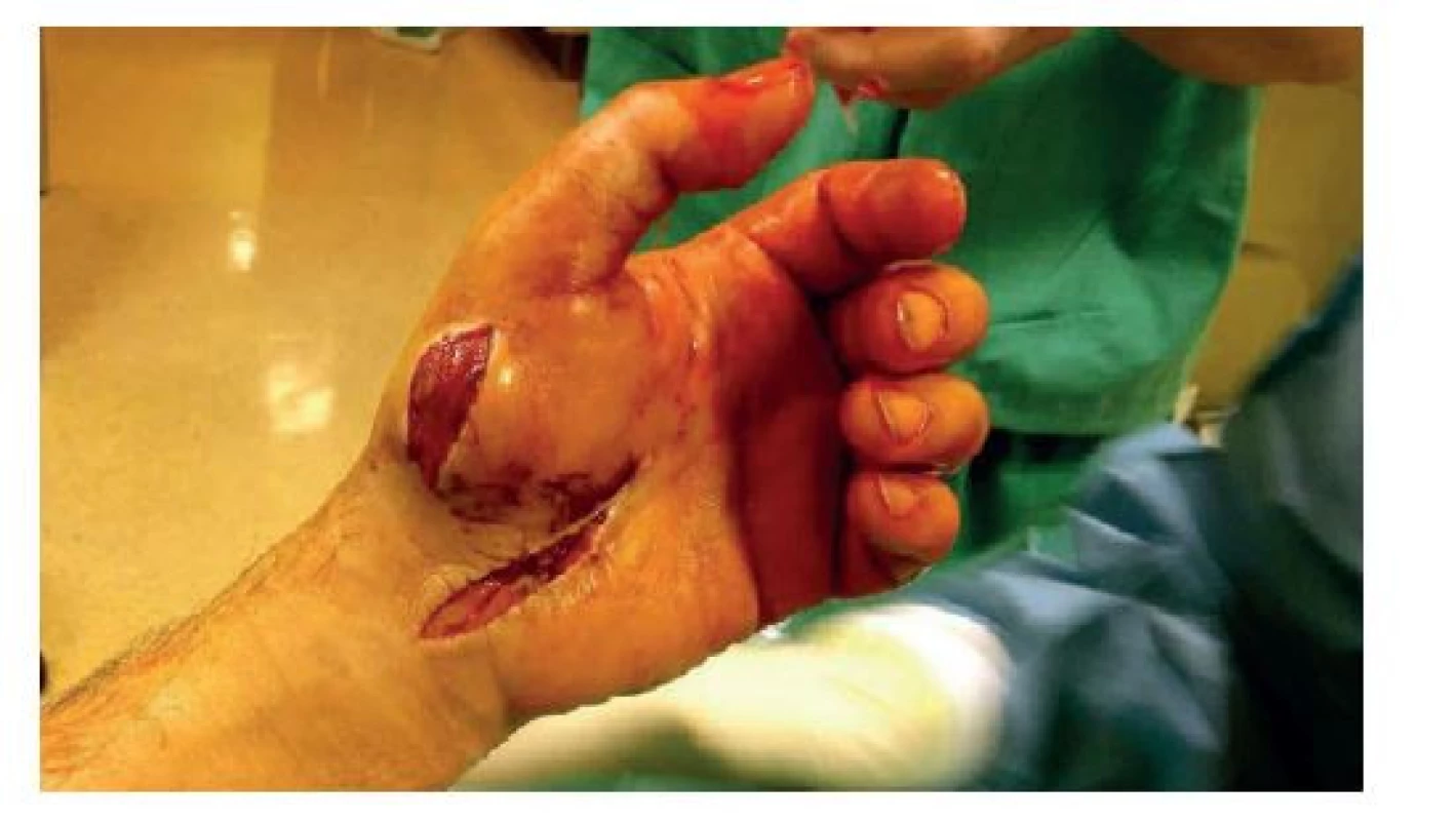 Incize thenaru a deliberace n.medianus vlevo<br>
Fig. 2: Thenar incision and liberation of the median nerve
on the left