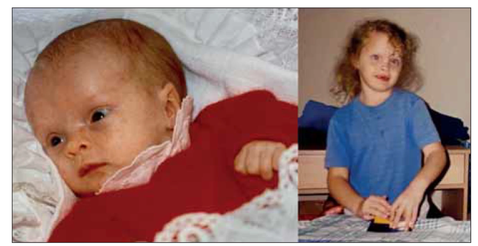 Fotografi e pacientky ve 4 měsících a v 8 letech věku poskytnuté jejími rodiči.
Patrná kraniofaciální dysmorfie: makrocefalie, prominující čelo, hypertelorismus, nízce
posazené uši, strabismus.<br>
Fig. 1. Photographs of the patient taken when she was 4 months and 8 years old
provided by her parents. Craniofacial dysmorphic features include macrocephaly,
bossing forehead, hypertelorism, low set ears and strabism.