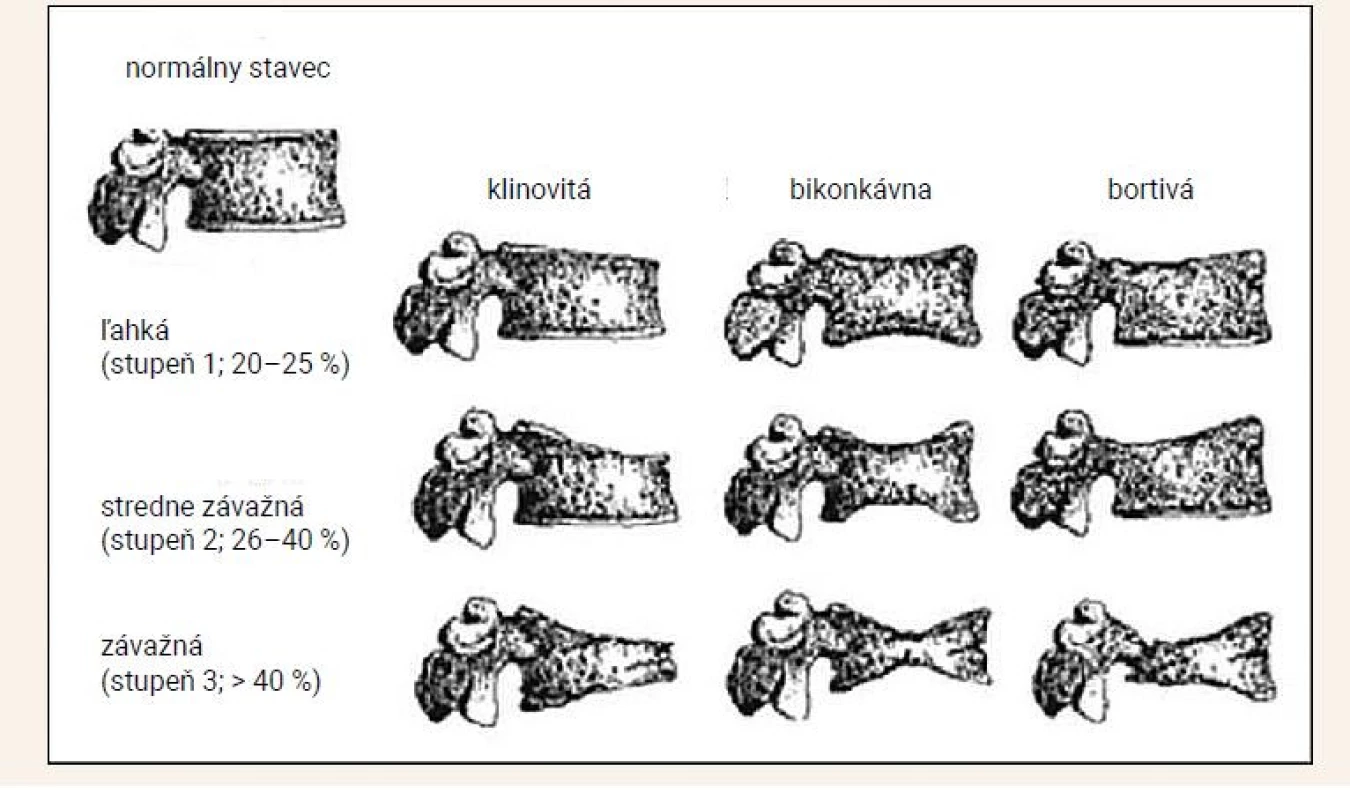 Semikvantitatívne hodnotenie zlomenín stavcov podľa Genanta. Upravené podľa Genant HK, Wu CY,
van Kuijk C et-al. Vertebral fracture assessment using a semiquantitative technique. J Bone Miner Res 1993;
8(9): 1137–1148.