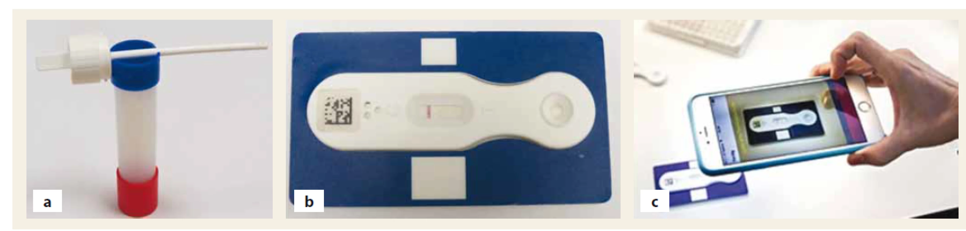 Samovyšetření fekálních hladin kalprotektinu systémem CalproSmart.<br>
Fig. 1. Self-examination of fecal calprotectin levels by the CalproSmart system.<br>
1a. Odběrová souprava k extrakci kalprotektinu ze stolice a ke zhotovení fekálního eluátu sestává z plastové zkumavky
obsahující extrakční pufr, a z dříku s drážkami, do kterých se vejde přesné kvantum stolice. Dřík se ponoří 3–5× do vzorku
stolice, poté se vloží do zkumavky s extrakčním pufrem a mícháním po dobu 2 min je zhotoven eluát.<br>
1b. Principem měření je laterální průtoková analýza. Testovací nitrocelulózová membrána je potažena monoklonálními protilátkami
proti kalprotektinu. Sekundární zvířecí detekční protilátky konjugované na částice koloidního zlata jsou naneseny na
podložku uvolňující konjugát. Do reakčního systému se uvolní po přidání několika kapek extrahovaného fekálního eluátu stolice.
Zlatý konjugát kalprotektin/ anti-kalprotektin se naváže na anti-kalprotektinové protilátky navázané na testovací membráně
(testovací linie) a zbývající volný anti-kalprotektinový zlatý konjugát se naváže na zvířecí protilátky navázané na testovací
membráně (kontrolní linie). Intenzita signálu testovací linie a kontrolní linie je nasnímána aplikací, která je obsluhována z pacientova
chytrého telefonu.<br>
1c. Software ke snímkování reakce si pacient stáhne do svého mobilního telefonu zdarma ze známých zdrojů (Google
Play nebo AppStore). Data z pacientova chytrého telefonu jsou po pořízení fotografie online přenášena na evaluační server
výrobce soupravy, kde je provedeno měření intenzity reakce testovacího a kontrolního proužku a hodnota koncentrace fekálního
kalprotektinu (FC – fecal calprotectin) se během několika vteřin objeví jak na displeji pacientova telefonu, tak i v databázi
jeho ošetřujícího lékaře. Hladiny FC jsou navíc na displeji pacientova mobilního telefonu znázorněny semaforově – fekální hladiny
< 200 μg/ g zeleně (bezpečná koncentrace), hladiny 201–500 μg/ g oranžově (varovná koncentrace) a hladiny > 501 μg/ g červeně
(nebezpečná koncentrace). Aplikace umožňuje dlouhodobé grafi cké znázornění vývoje hladin FC v čase, díky kterému se
pacient může ujistit o stabilitě svého stavu, případně analyzovat neobvyklé výkyvy.