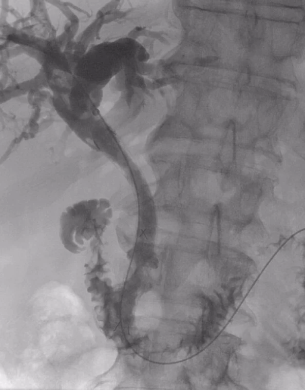 Stent v <i>ductus hepatocholedochus</i> 3 dny po implantaci
