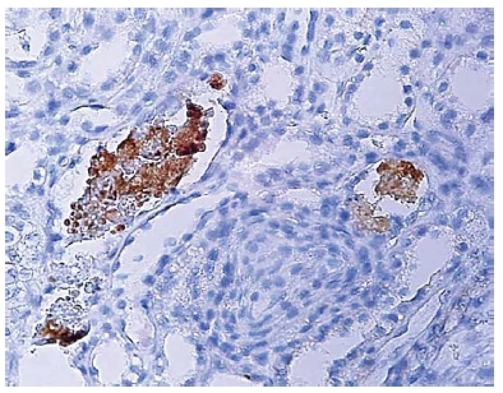 Imunohistochemický průkaz myoglobinu ve vločkovitém válci v luminu
tubulu (zvětšení 400x).