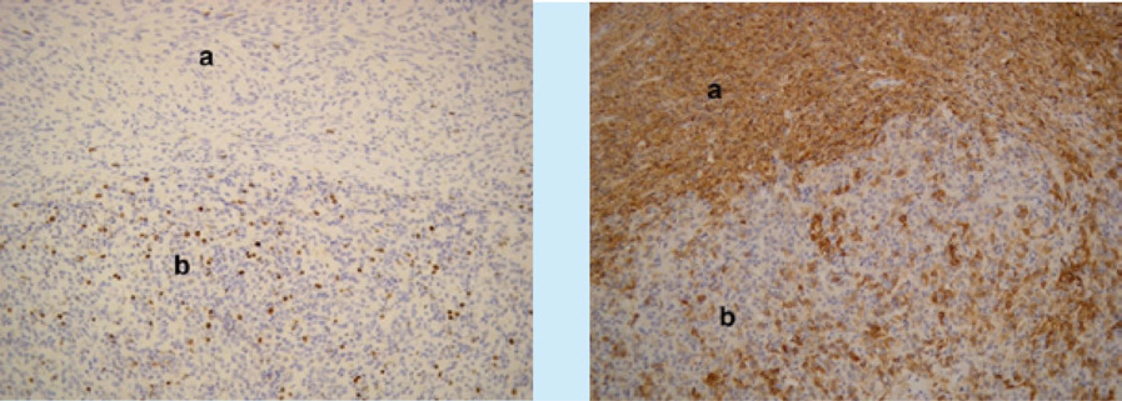 Mikroskopické obrazy stromálního tumoru nejistého maligního potenciálu (Stromal Tumor of Uncertain Malignant Potential, STUMP) včetně imunohistochemického hodnocení. Vlevo (zvětšení 40×, barvení hematoxylin-eozin)
lobulárně uspořádané nádorové ložisko (a), obdané silným vazivovým pouzdrem (b). Vpravo (zvětšení 200×, desmin)
pozitivní imunohistochemická reakce v obou typech nádorových elementů<br>
Fig. 3. Microscopic images of STUMP, including immunohistochemical evaluation. On the left (magnification 40 ×,
hematoxylin-eosin staining) lobularly arranged tumor foci (a), endowed with a strong fibrous sheath (b). On the right
(magnification 200 ×, desmin) positive immunohistochemical reaction in both types of tumor elements